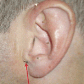 Battlefield acupuncture