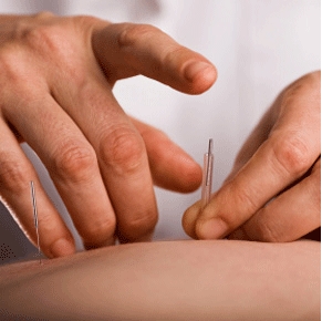 Acupuncture