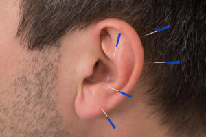 Auricular Acupuncture