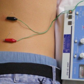 Electro Acupuncture